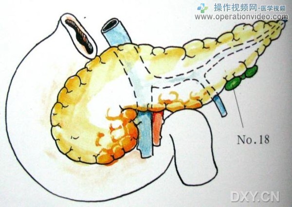 胰下淋巴结胰下淋巴结（No.18）位于胰体尾交界处下缘。.jpg