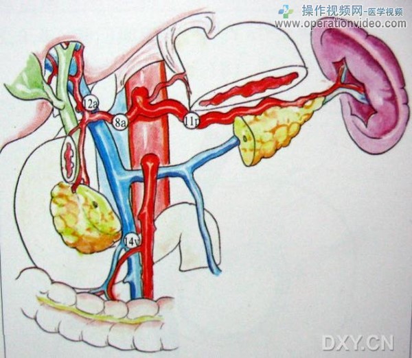 移去一段胰腺，看门静脉及肠系膜上血管处的淋巴结.jpg