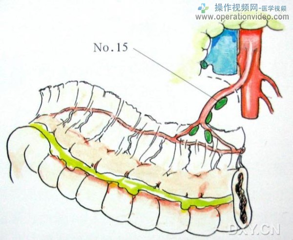 中结肠动脉周围淋巴结中结肠动脉周围淋巴结（No.15）位于横结肠系膜内，中结肠动脉旁。.jpg