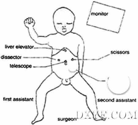 Fig. 3. Laparoscopic approach with trocars and surgeons’ arrangement.