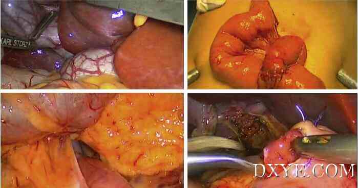 Fig. 4. Intraoperative choledochal cyst; Jejunojejunostomy; Retrocolic hepaticojejunostomy Roux-en-Y ...