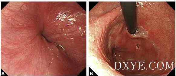 食管胃吻合瓣膜成形术（图解）减少术后反流的吻合技巧