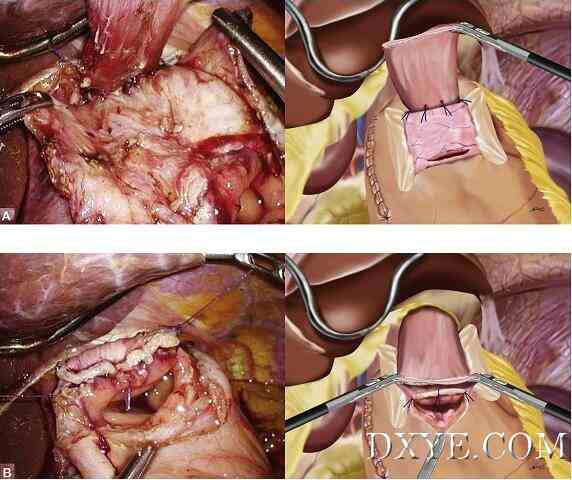 食管胃吻合瓣膜成形术（图解）减少术后反流的吻合技巧
