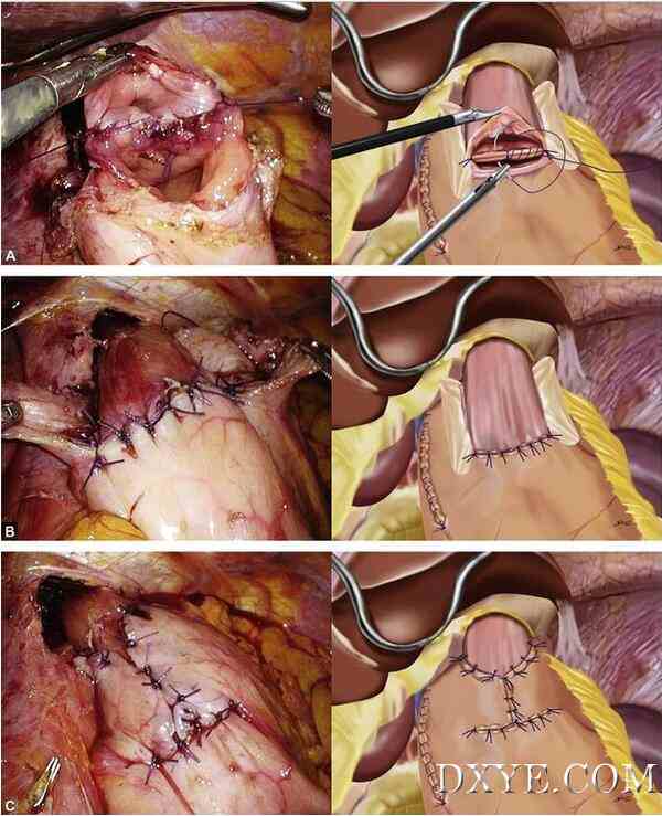 食管胃吻合瓣膜成形术（图解）减少术后反流的吻合技巧