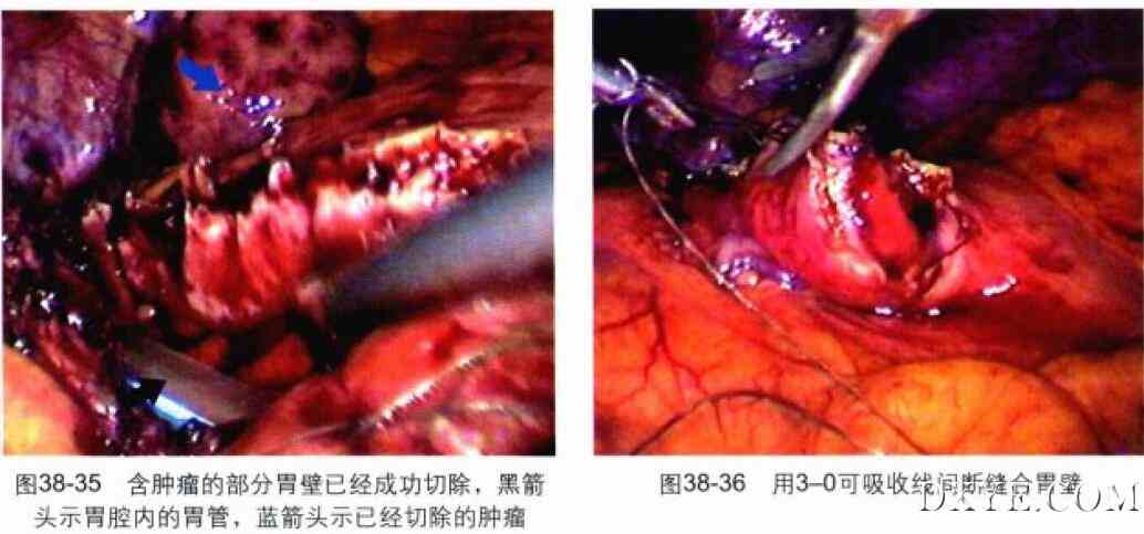 腹腔镜胃大部分切除术