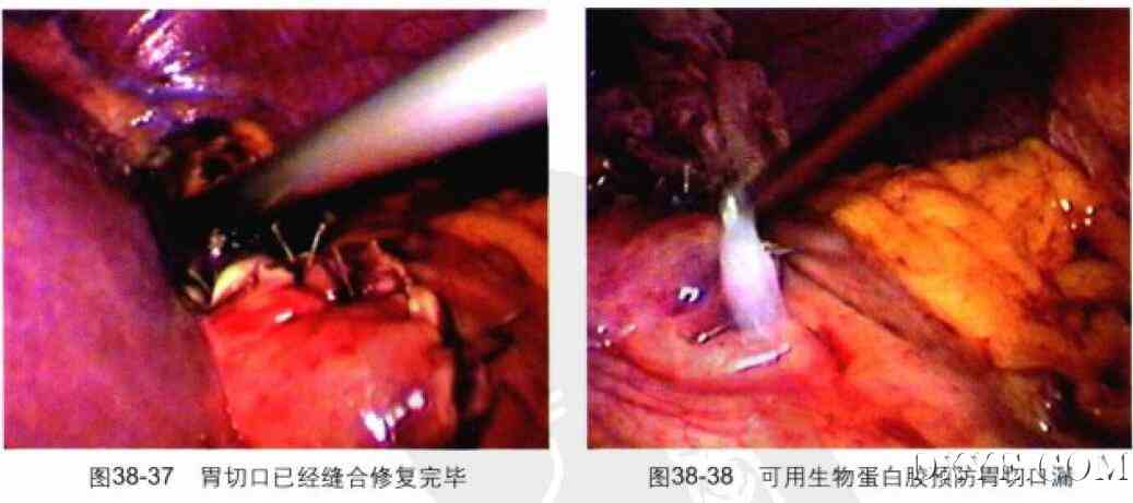 腹腔镜胃大部分切除术