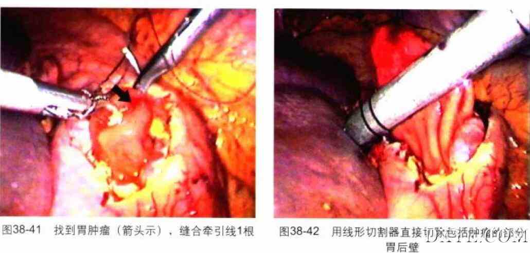 腹腔镜胃大部分切除术