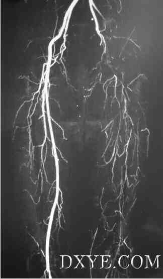 Fig 1. Computed tomography (CT) angiogram of patient 3 showing external iliac occlusion with no refo ...