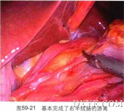 腹腔镜辅助结肠间质瘤切除术