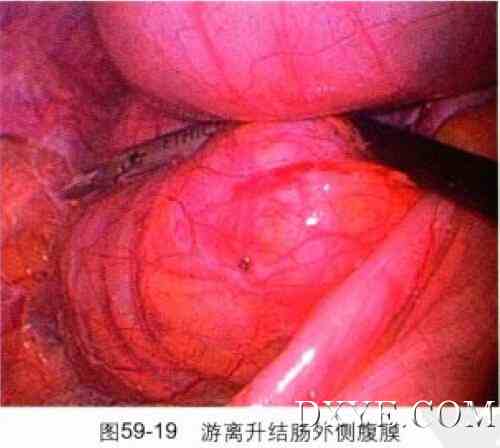 腹腔镜辅助结肠间质瘤切除术