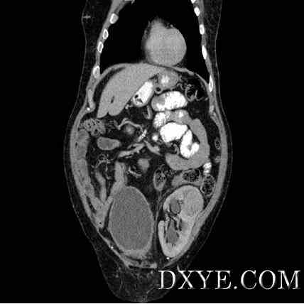 Figure 1: Coronal computed tomography (CT) image with contrast.