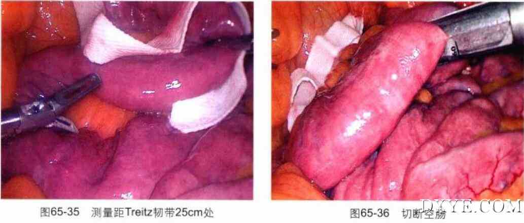 腹腔镜胃束带转胃旁路术