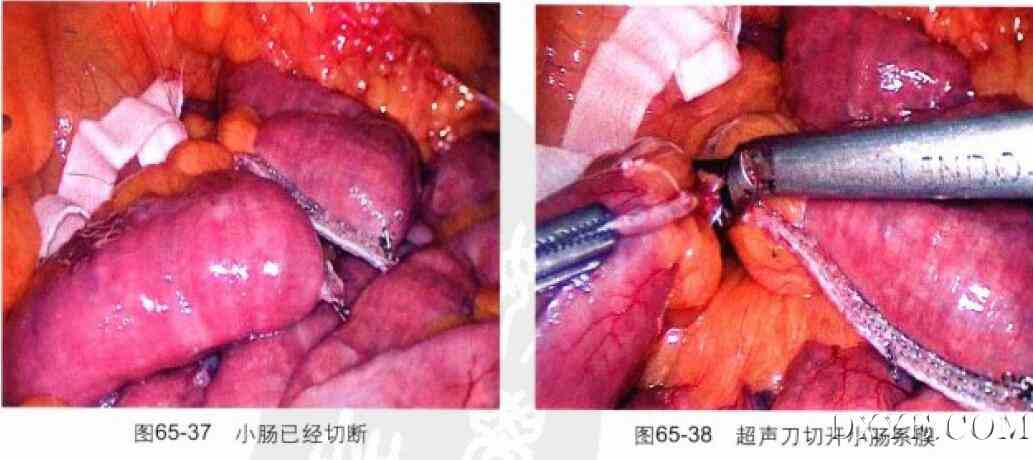 腹腔镜胃束带转胃旁路术