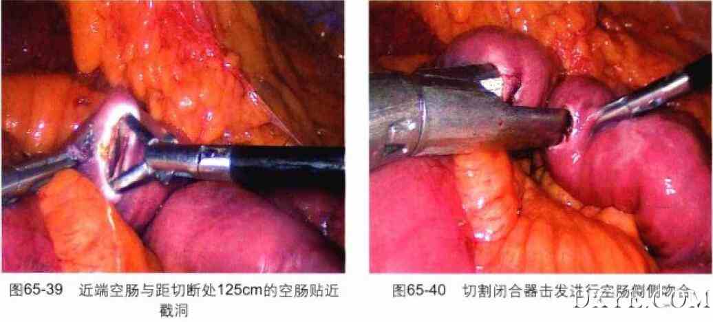 腹腔镜胃束带转胃旁路术