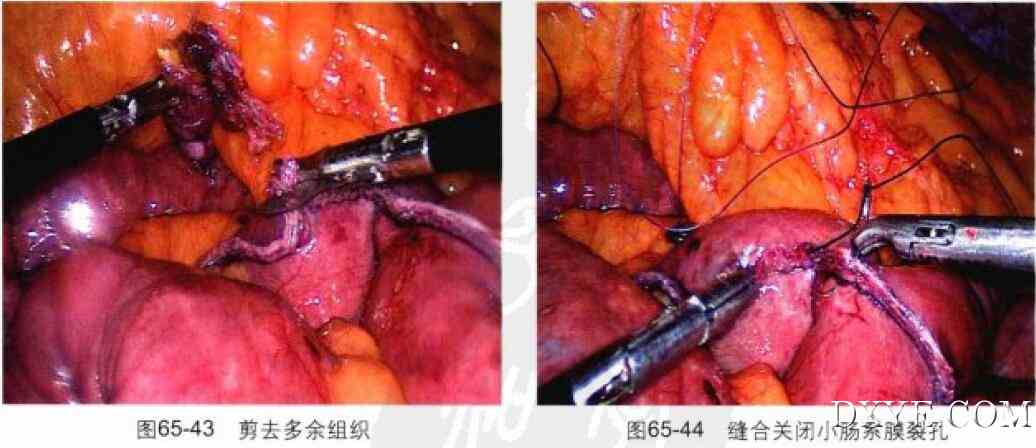 腹腔镜胃束带转胃旁路术