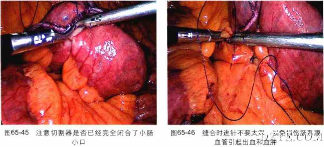 腹腔镜胃束带转胃旁路术