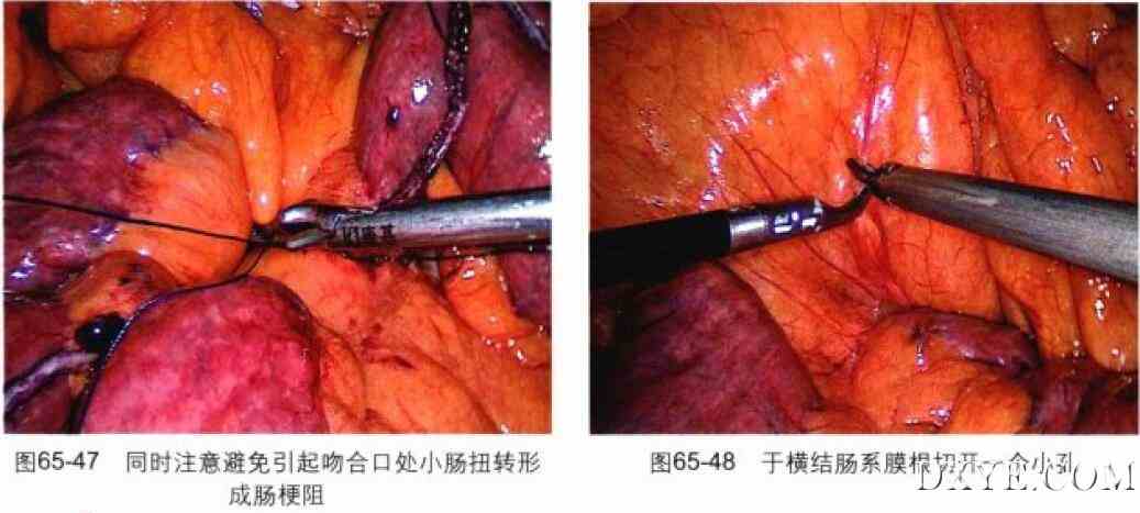 腹腔镜胃束带转胃旁路术