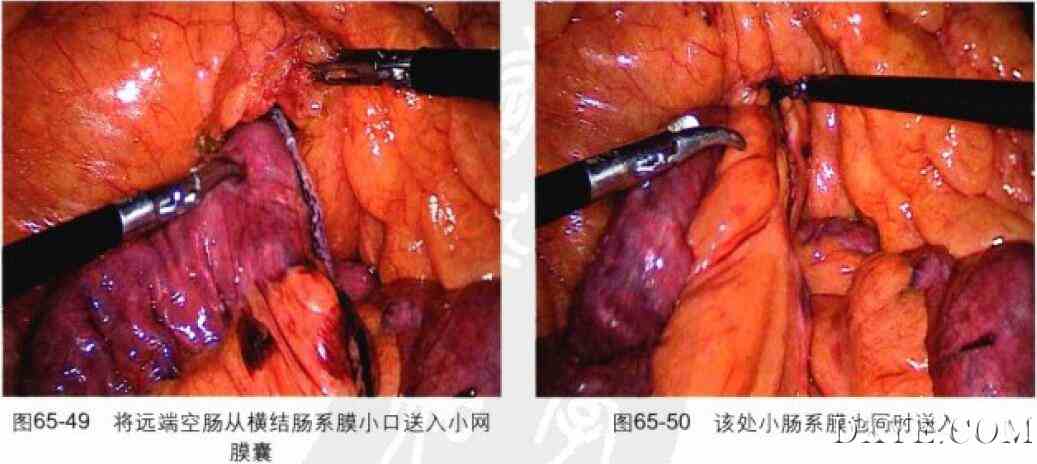 腹腔镜胃束带转胃旁路术