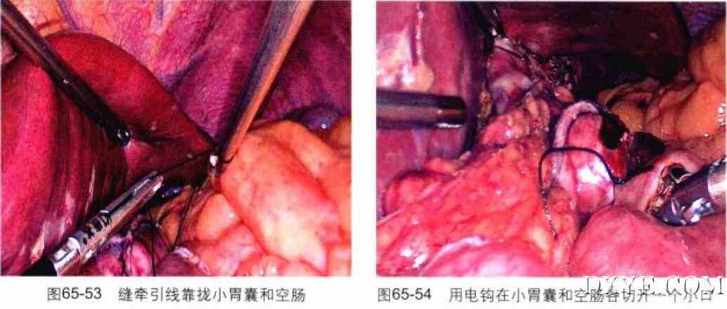 腹腔镜胃束带转胃旁路术