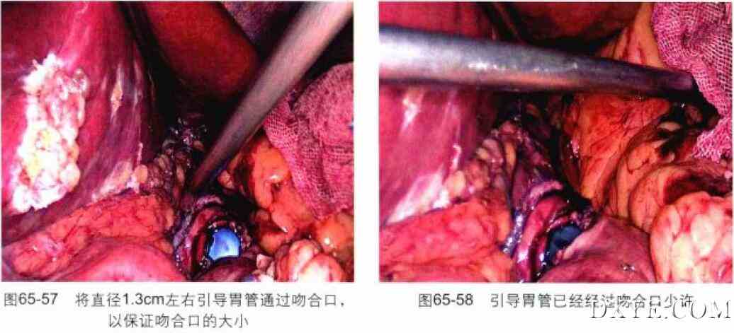 腹腔镜胃束带转胃旁路术