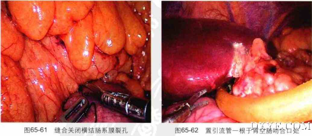 腹腔镜胃束带转胃旁路术