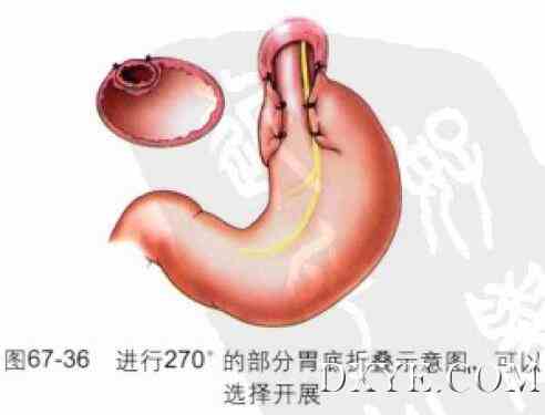 腹腔镜食管裂孔疝修补、胃底折叠术