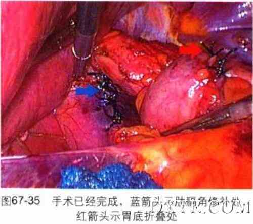 腹腔镜食管裂孔疝修补、胃底折叠术