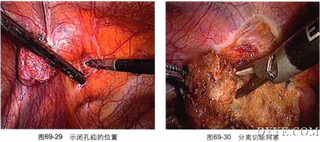 经腹腔腹膜前腹腔镜腹股沟疝修补术（TAPP）