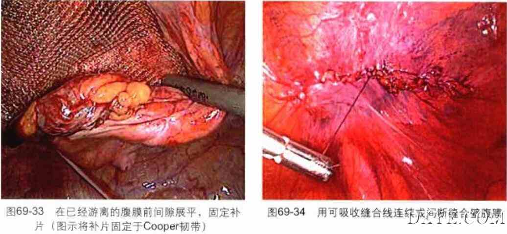 经腹腔腹膜前腹腔镜腹股沟疝修补术（TAPP）