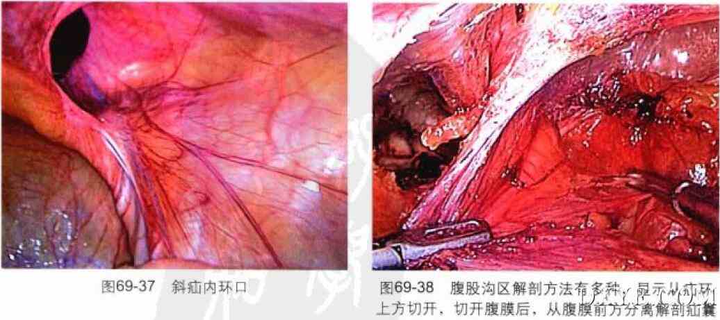 经腹腔腹膜前腹腔镜腹股沟疝修补术（TAPP）