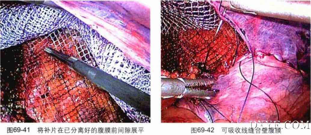 经腹腔腹膜前腹腔镜腹股沟疝修补术（TAPP）