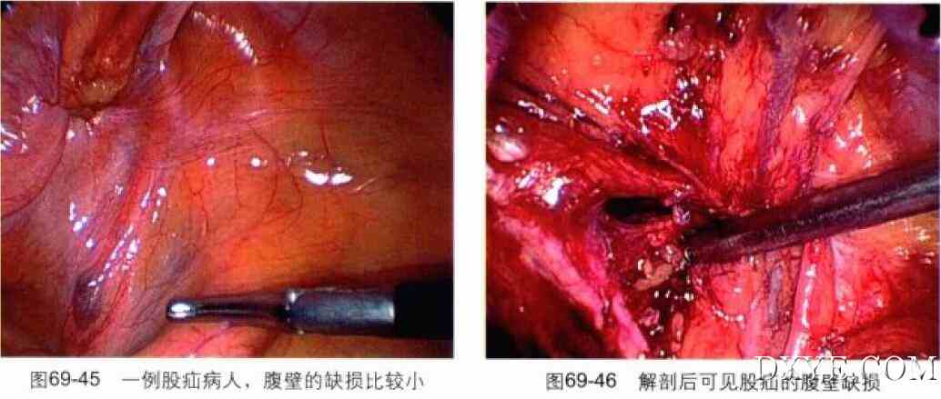 经腹腔腹膜前腹腔镜腹股沟疝修补术（TAPP）