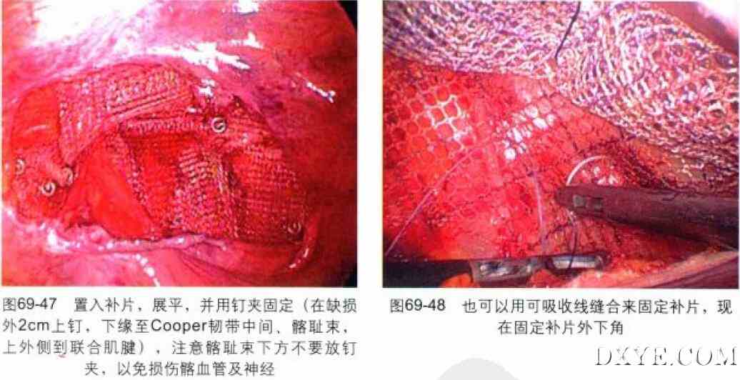 经腹腔腹膜前腹腔镜腹股沟疝修补术（TAPP）