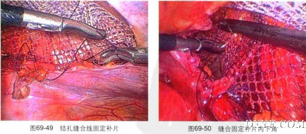 经腹腔腹膜前腹腔镜腹股沟疝修补术（TAPP）