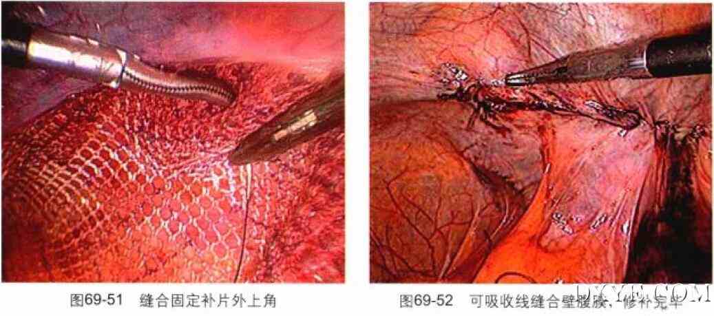 经腹腔腹膜前腹腔镜腹股沟疝修补术（TAPP）