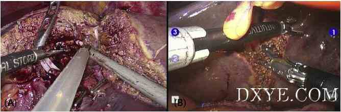 Figure 1. (A) Laparoscopic and (B) robotic left lateral sectionectomy.