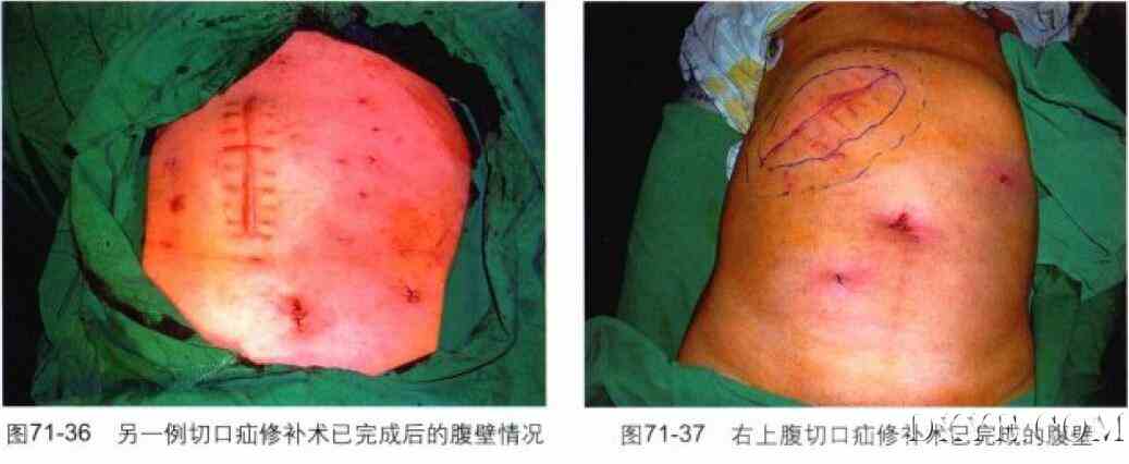 腹腔镜腹壁切口疝修补术