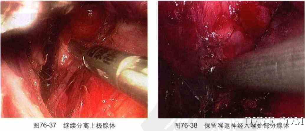 完全乳晕入路腔镜甲状腺次全切除术