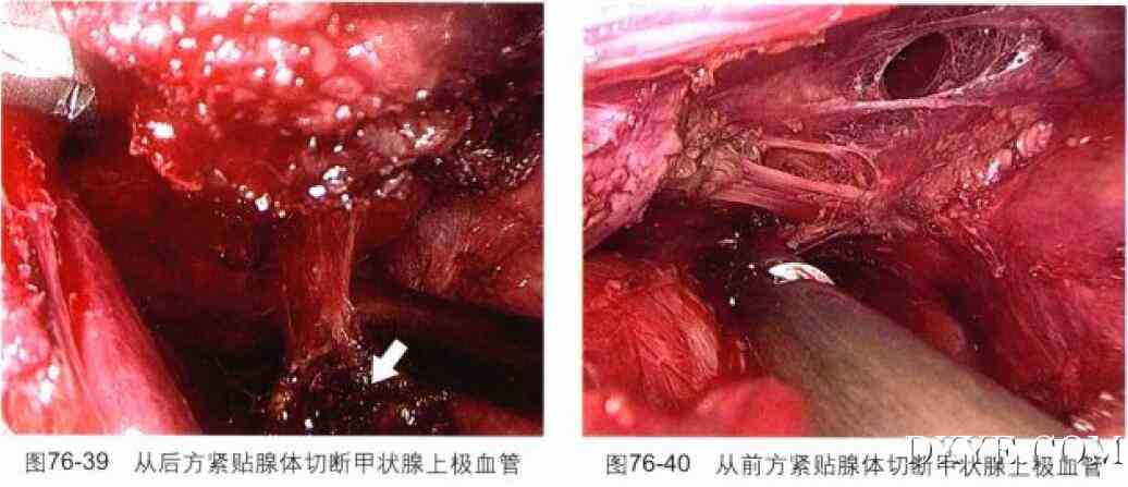 完全乳晕入路腔镜甲状腺次全切除术