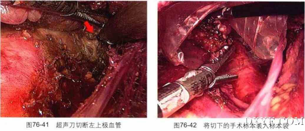 完全乳晕入路腔镜甲状腺次全切除术