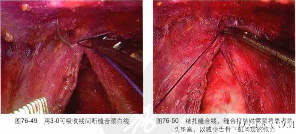 完全乳晕入路腔镜甲状腺次全切除术