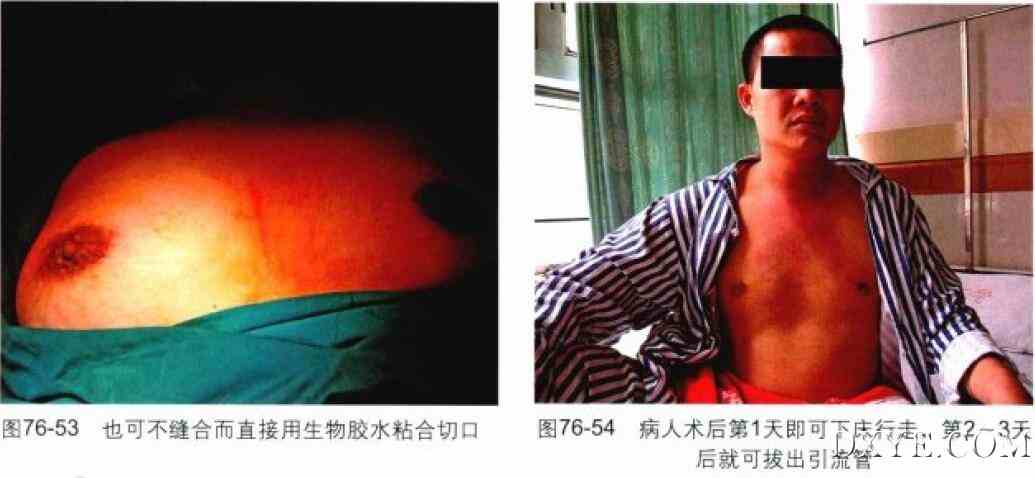 完全乳晕入路腔镜甲状腺次全切除术