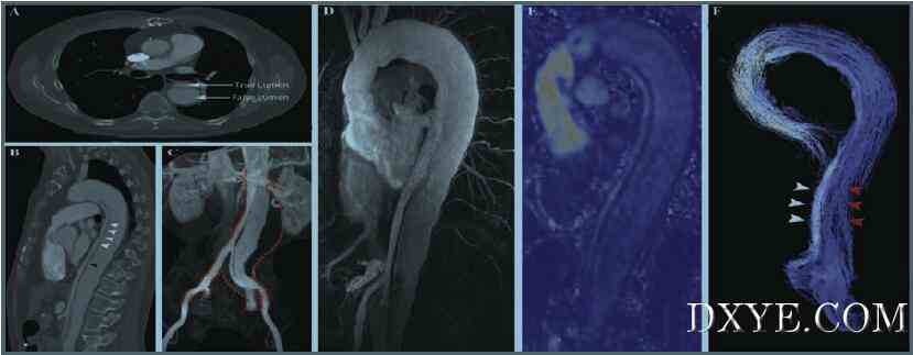 Fig. Chronic aortic dissection and 4D MR aortic blood flow.
