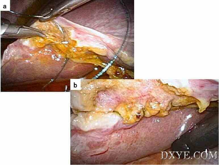 倒钩缝合术在腹腔镜胆囊切除术中胆管损伤修复中的应用——附2例报告
