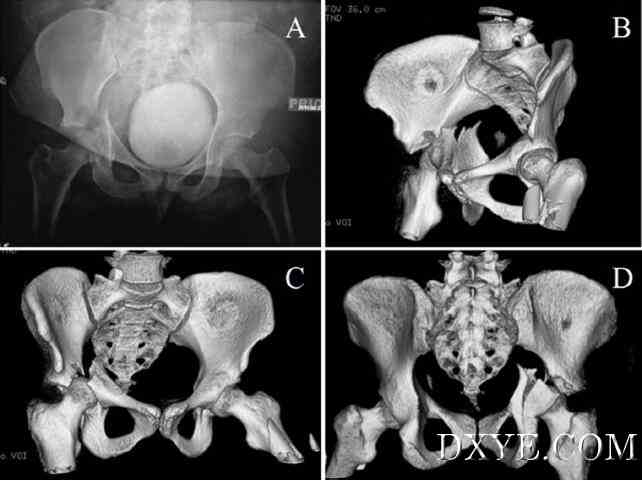 灵活的3D腹腔镜辅助复位和经皮固定治疗髋臼骨折-新手术方案的介绍