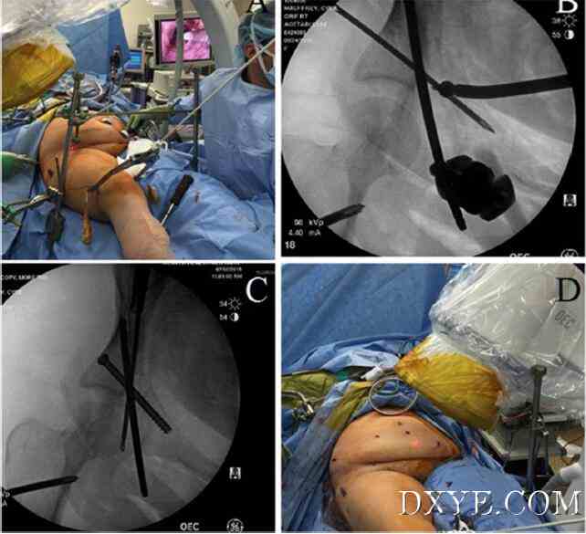 灵活的3D腹腔镜辅助复位和经皮固定治疗髋臼骨折-新手术方案的介绍