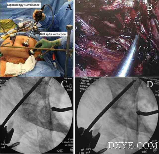 灵活的3D腹腔镜辅助复位和经皮固定治疗髋臼骨折-新手术方案的介绍