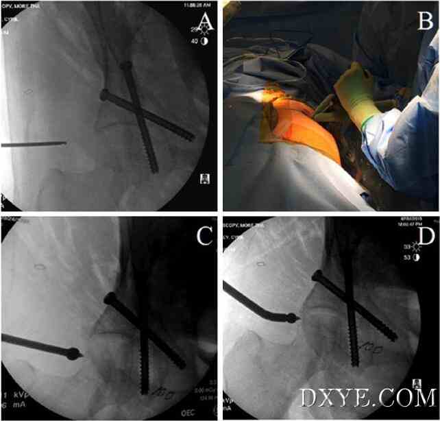 灵活的3D腹腔镜辅助复位和经皮固定治疗髋臼骨折-新手术方案的介绍