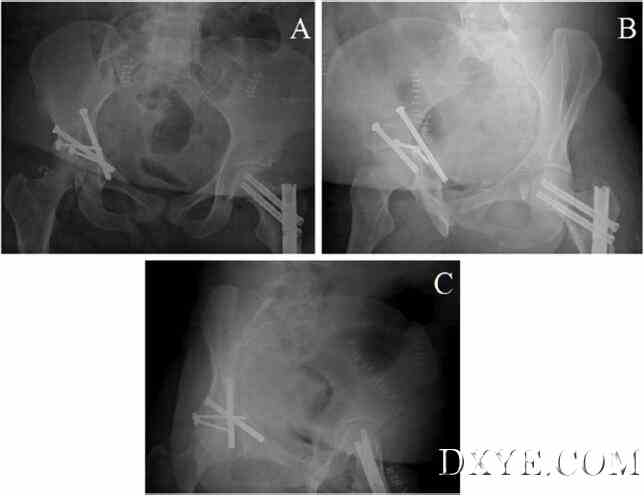 灵活的3D腹腔镜辅助复位和经皮固定治疗髋臼骨折-新手术方案的介绍