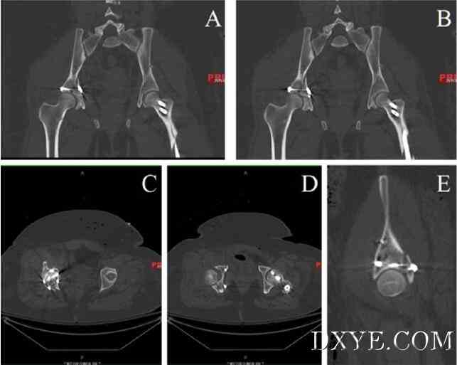 灵活的3D腹腔镜辅助复位和经皮固定治疗髋臼骨折-新手术方案的介绍